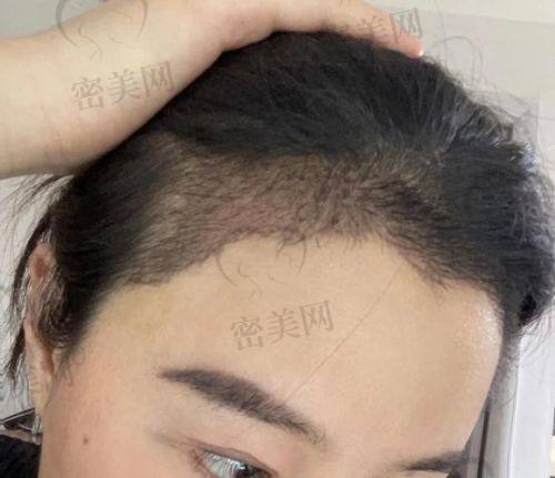 广州美莱植发中 心 - 陈育哲医生