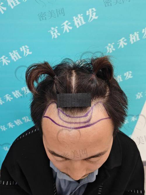 大同丽和毛发医疗美容：环境舒适，术中体验感受好