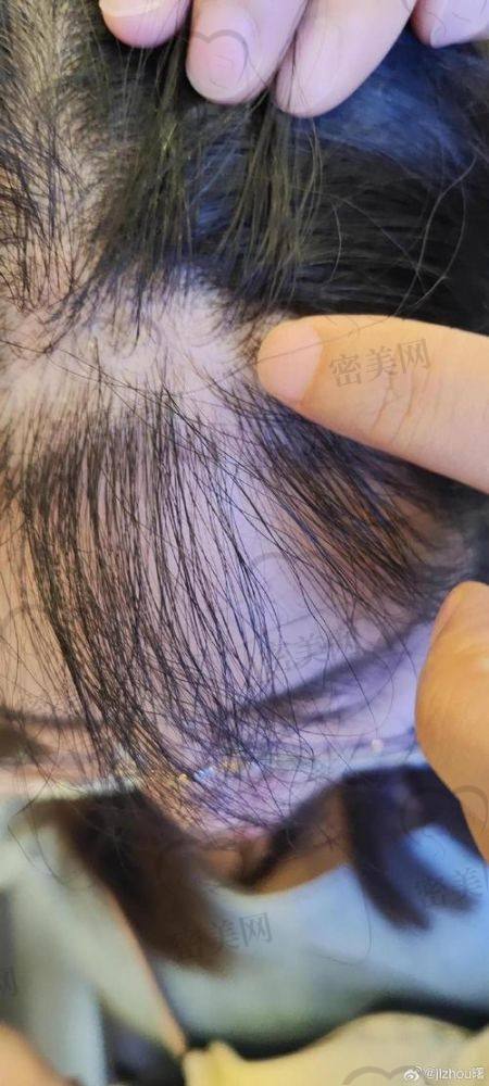 大同德尔美客医疗美容植发：高性价比选择，局部种植项目亮眼