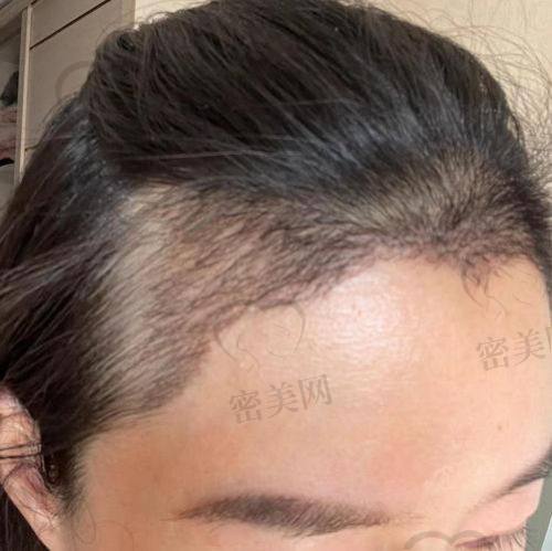 大同圣莲心医疗美容植发：擅长特色项目，如疤痕再生种植