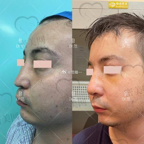 鼻基底填充后遗症要注意