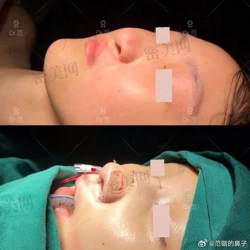 鼻基底填充前后对比超震撼