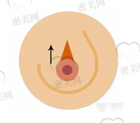 潘峰医生技术特点：