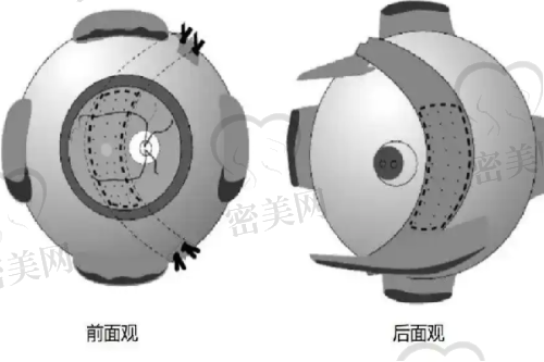 去除法令纹的常见方法