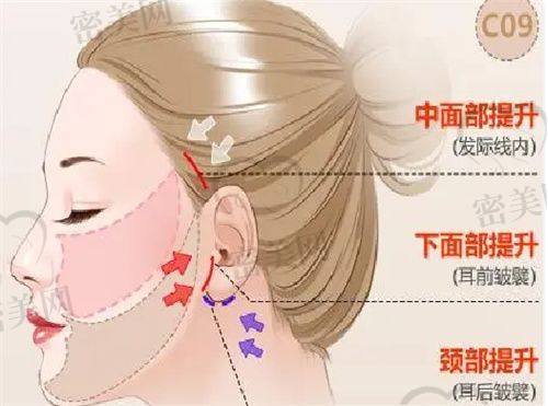 不同年龄段适合的整形项目