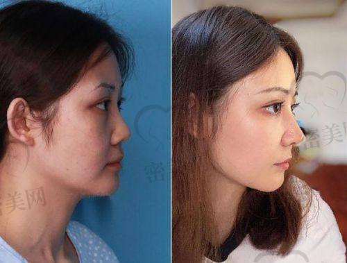 北京美莱王旭东医生做鼻子的术式&价格透明公开