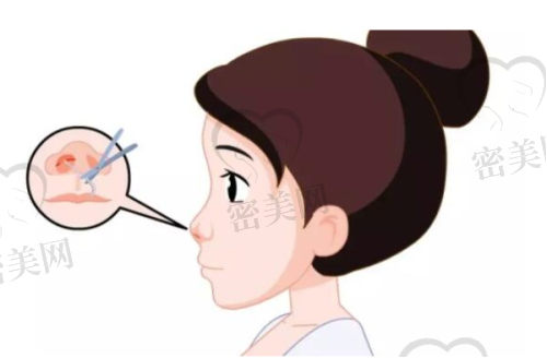适合找王旭东医生做鼻子的求美人群有哪些？