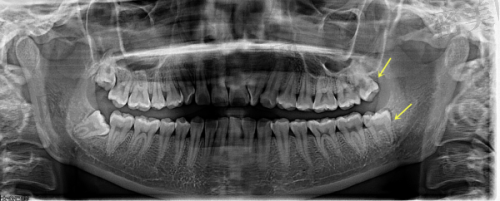 福州维乐口腔的特色诊疗—种植牙、正畸、儿牙