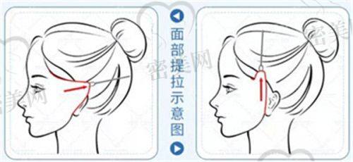 医美去除抬头纹的风险和注意事项
