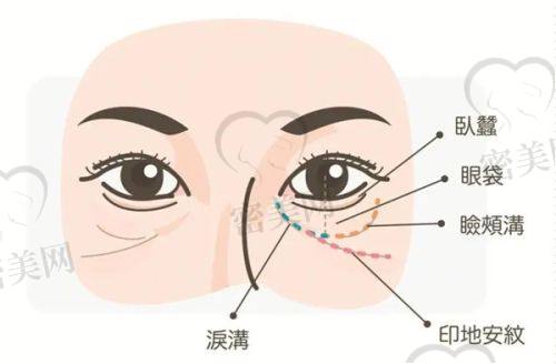 打玻尿酸多年后的成效揭秘