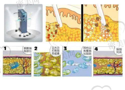 去除抬头纹的医美方法有哪些？