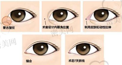去除抬头纹的风险与注意事项