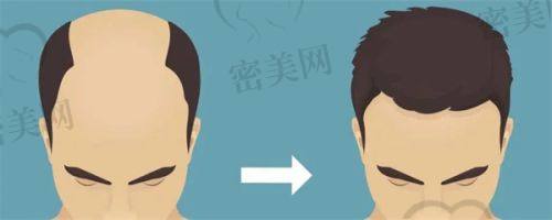 哈尔滨碧莲盛植发医院：技术实力派，术后成效自然