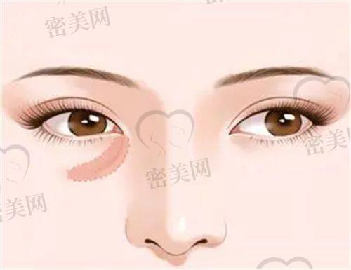 不花大钱的去除法令纹妙招
