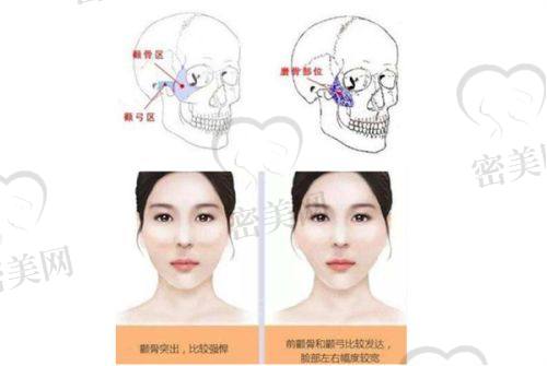 脂肪填充眼窝一年后图片对比震撼来袭