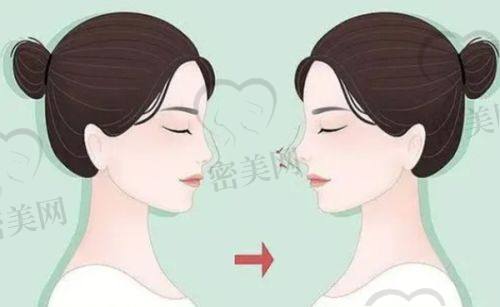 法令纹手术价格及是否恒久？
