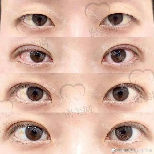 北京丰联丽格师丽丽S - ACC青芒双眼皮：真人实例大赏！