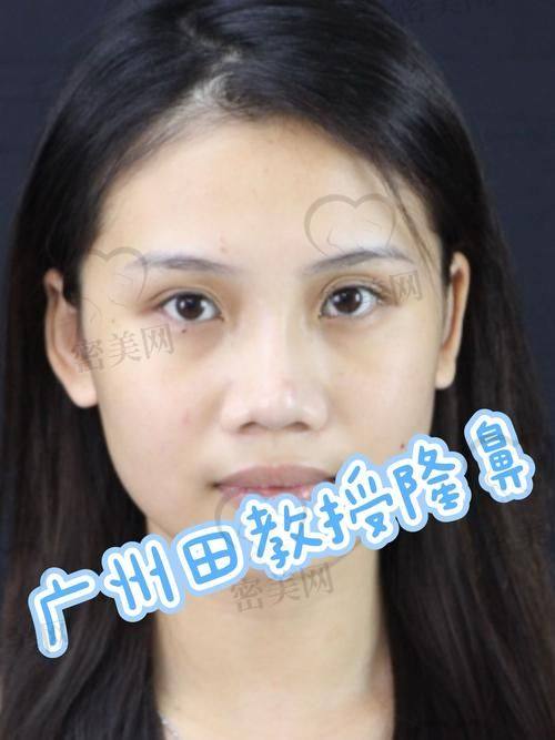 真实实例反馈：术后自然度高，修复快