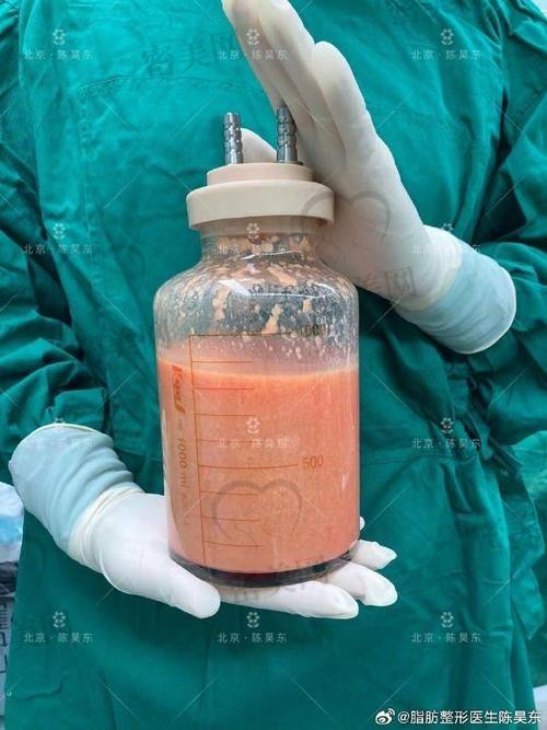 北京米兰柏羽丽都整形医院高海燕腰腹环吸：口碑爆棚啦