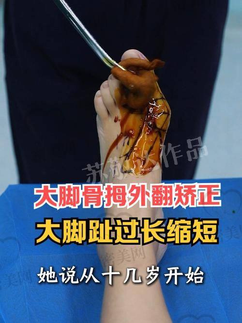 沈阳恒美外科专科门诊：微创设备硬科技代表