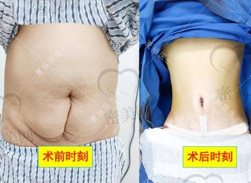 北京米兰柏羽丽都整形医院胡彬：腹壁成型价格大揭秘