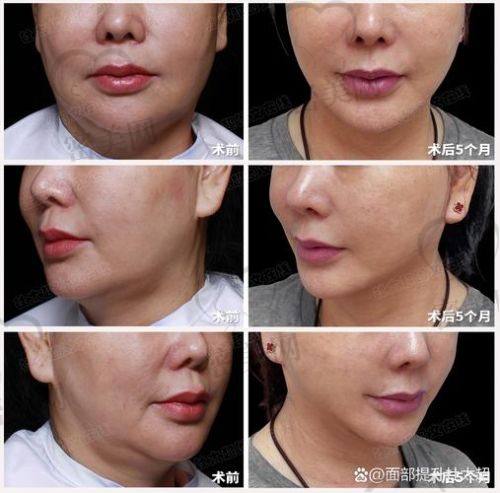 李晓东的拉皮实力，也不容小觑