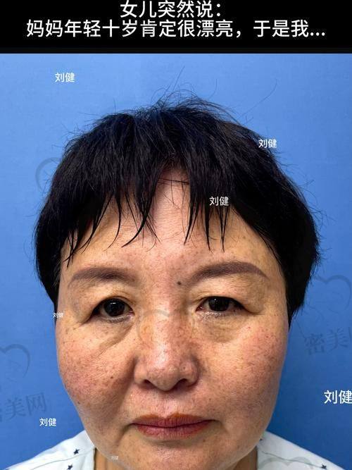 v 美减龄成效维持时长，北京加减美穆宝安面部提升能美多久