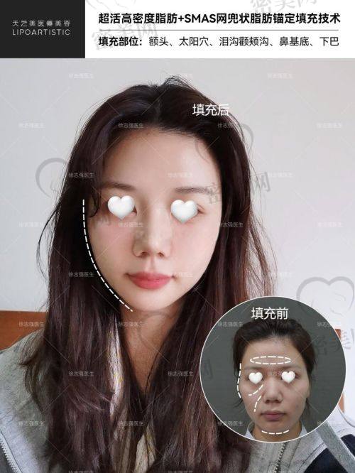 填充成效能维持多久