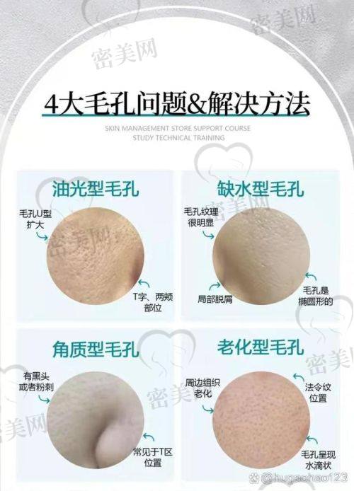 壬二酸凝胶15%真能收缩毛孔吗？