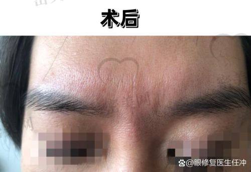 玻尿酸去川字纹有无后遗症
