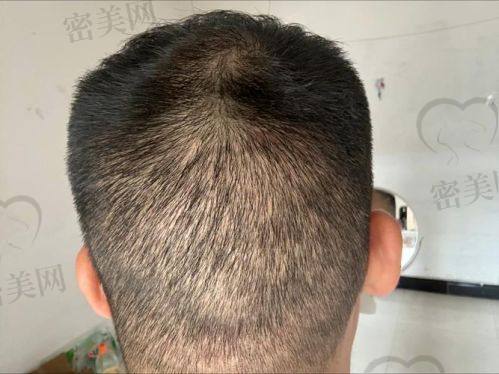 哈尔滨新生植发医院：种得多，养得好，一站式服务