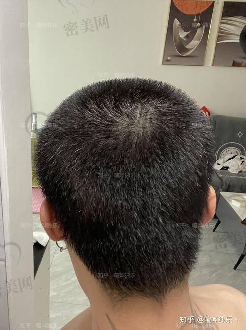 哈尔滨艺星医疗美容医院：微针植发+毛囊检测更科学