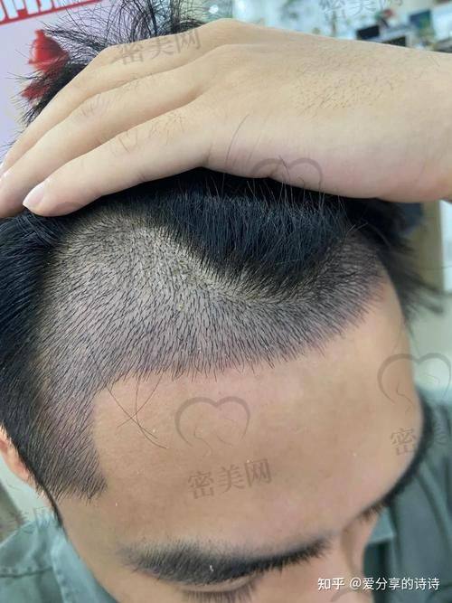 哈尔滨热门植发医院一览表