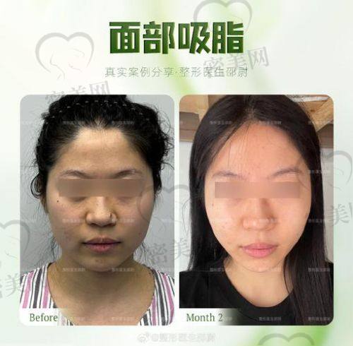 北京美莱田鹏吸脂收费标准咋样？