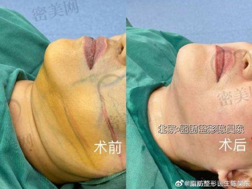 北京美莱田鹏吸脂成功实例大赏