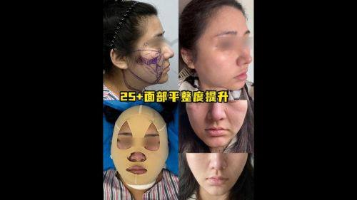 北京美莱田鹏吸脂技术优势大揭秘