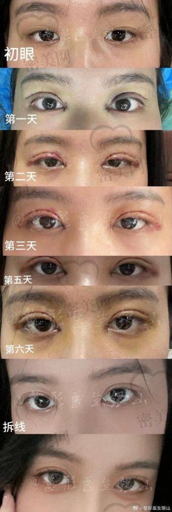 抓住机会：开启你的美眼新篇章
