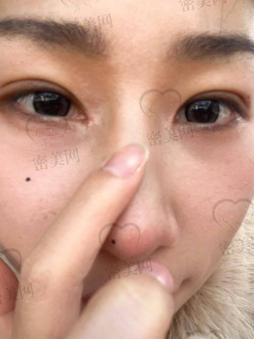 真人实例：见证内眼角回包的神奇成效