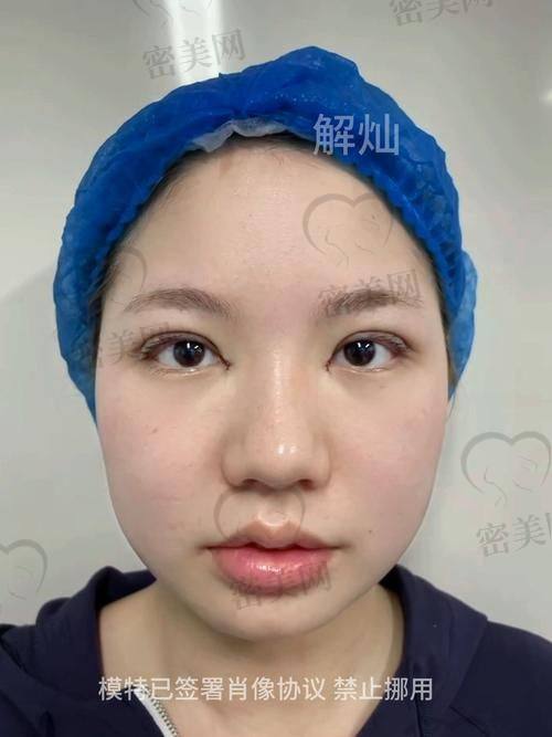 口碑爆棚：患者见证谢立宁内眼角回包的魅力