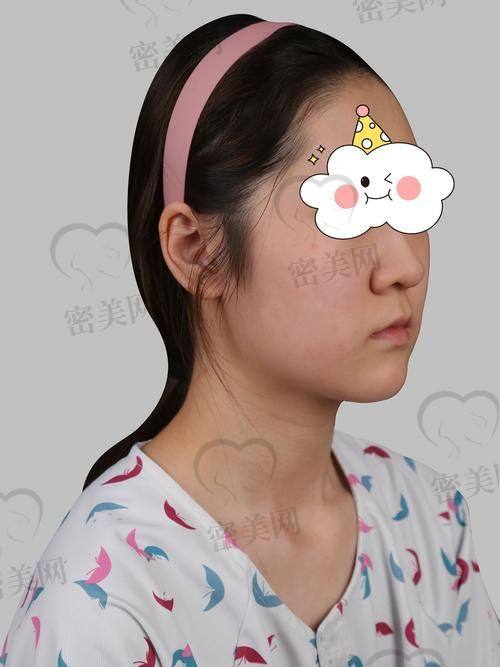 真人实例：ARSMO支架鼻综合，让你秒变得更美鼻达人！