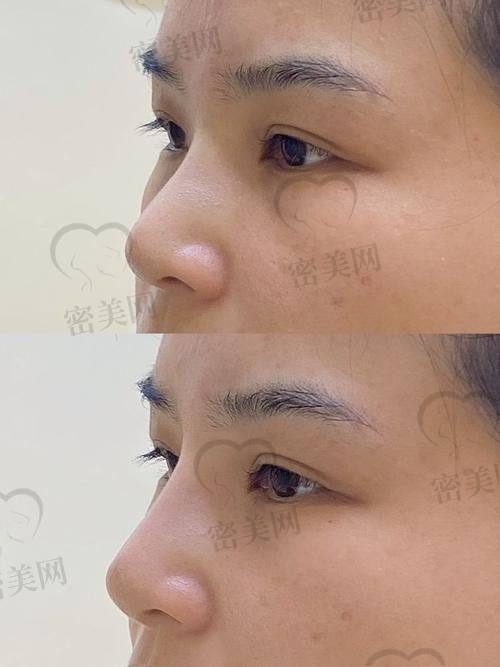 北京华韩谢立宁：4万起的ARSMO支架鼻综合，价格香到离谱！