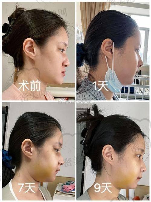 北京华韩整形医院黄旭培：真人实例见证美鼻奇迹