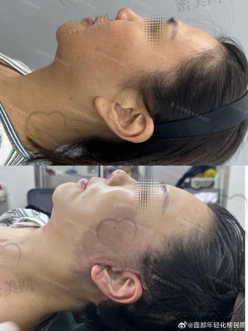 口碑爆棚：北京华韩谢立宁 59800 元面部大拉皮的魅力见证