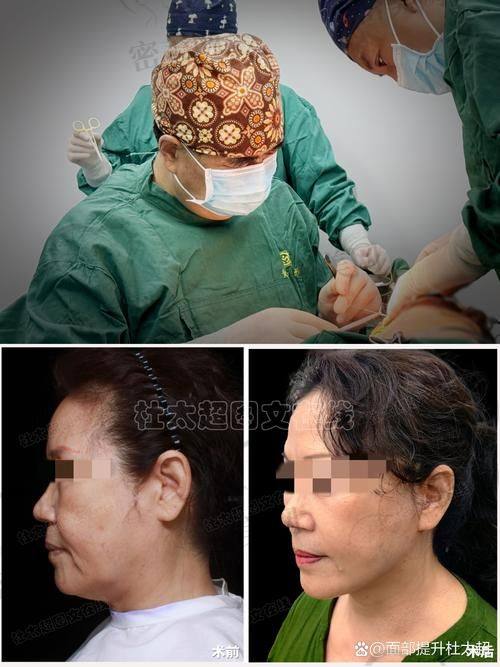 真人实例：北京华韩谢立宁 59800 元面部大拉皮的神奇成效展示