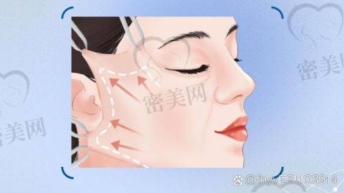 北京米兰柏羽丽都整形医院于晓春：中下面部埋线提升的口碑见证