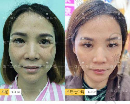 谢立宁医生：北京华韩的面部抗衰“魔法大师”