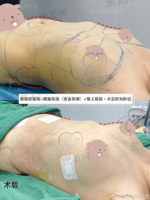 北京米兰柏羽丽都整形医院高海燕：脂肪丰胸 29800 起，性价比之王！