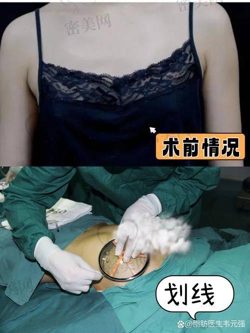 北京米兰柏羽丽都整形医院高海燕脂肪丰胸：优势大揭秘！