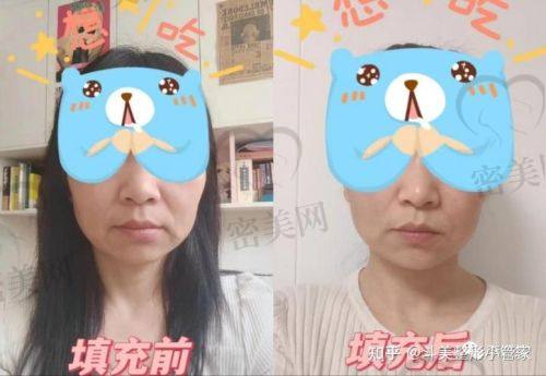 法令纹去除后的快乐生活