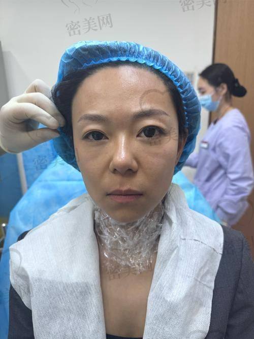 体验伊妍仕少女针填充法令纹